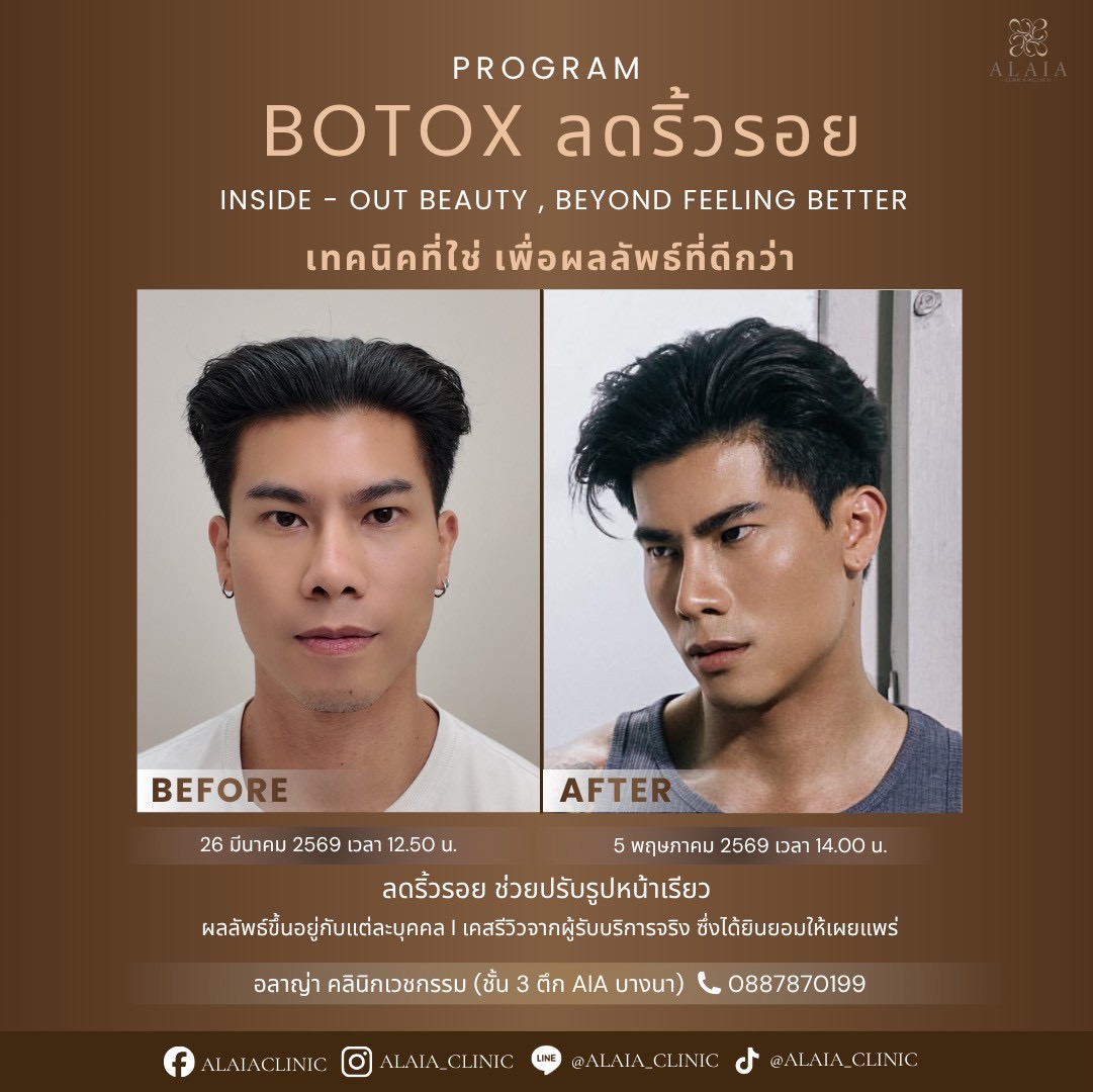 Botox Real Result 3